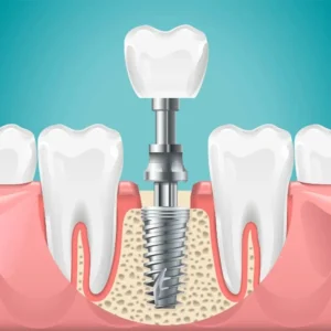 Enhancing Oral Health with Dental Implants: A Sustainability Perspective